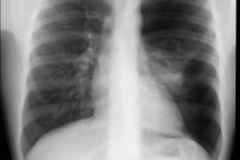 Odma opłucnowa lewostronna. Niedodma płuca lewego.