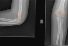 Złamanie nadkłykciowe lewej kości ramiennej.